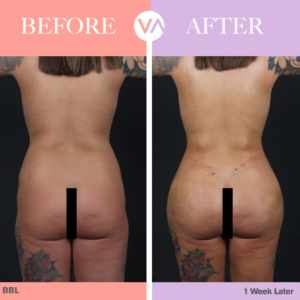 BBL Before After Photo
