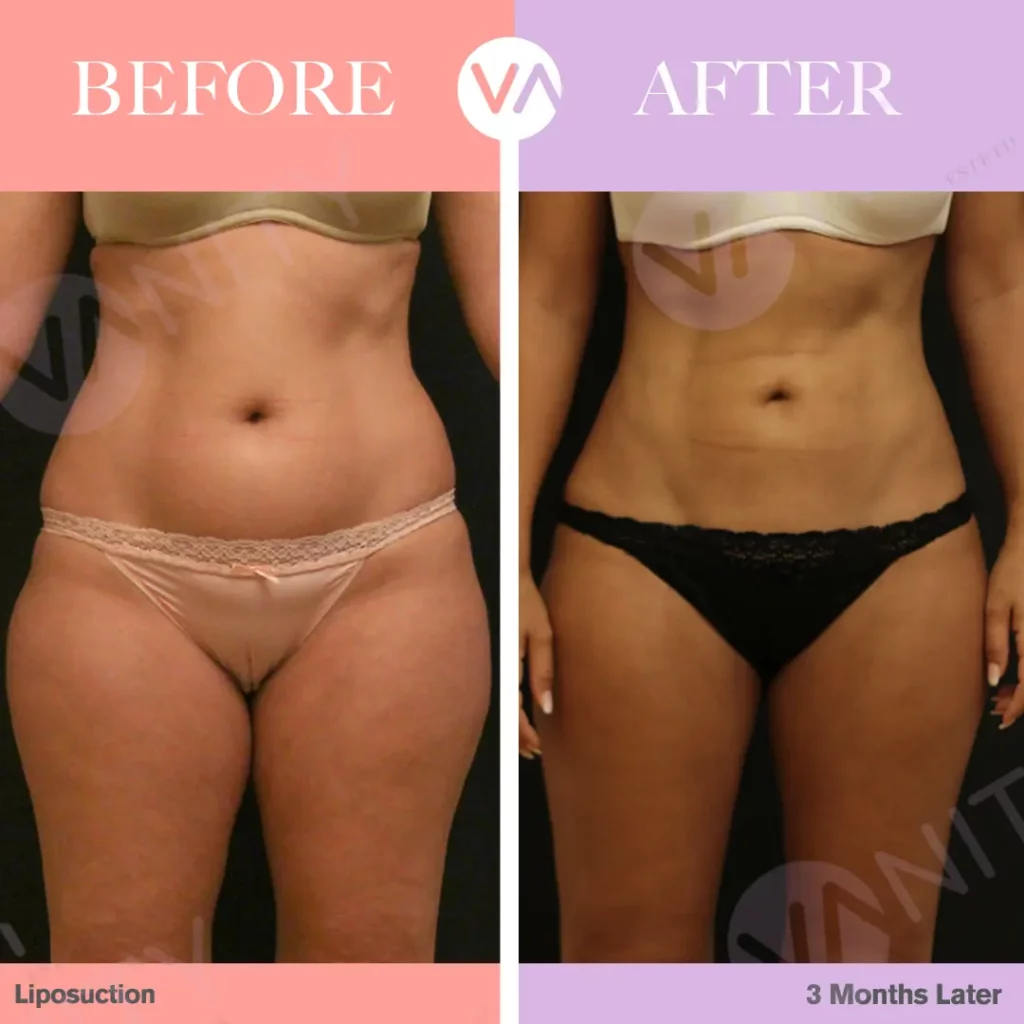 The Best Full Body VASER Liposuction Procedure Available