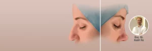 Kadri İla Burun Estetiği Afişi