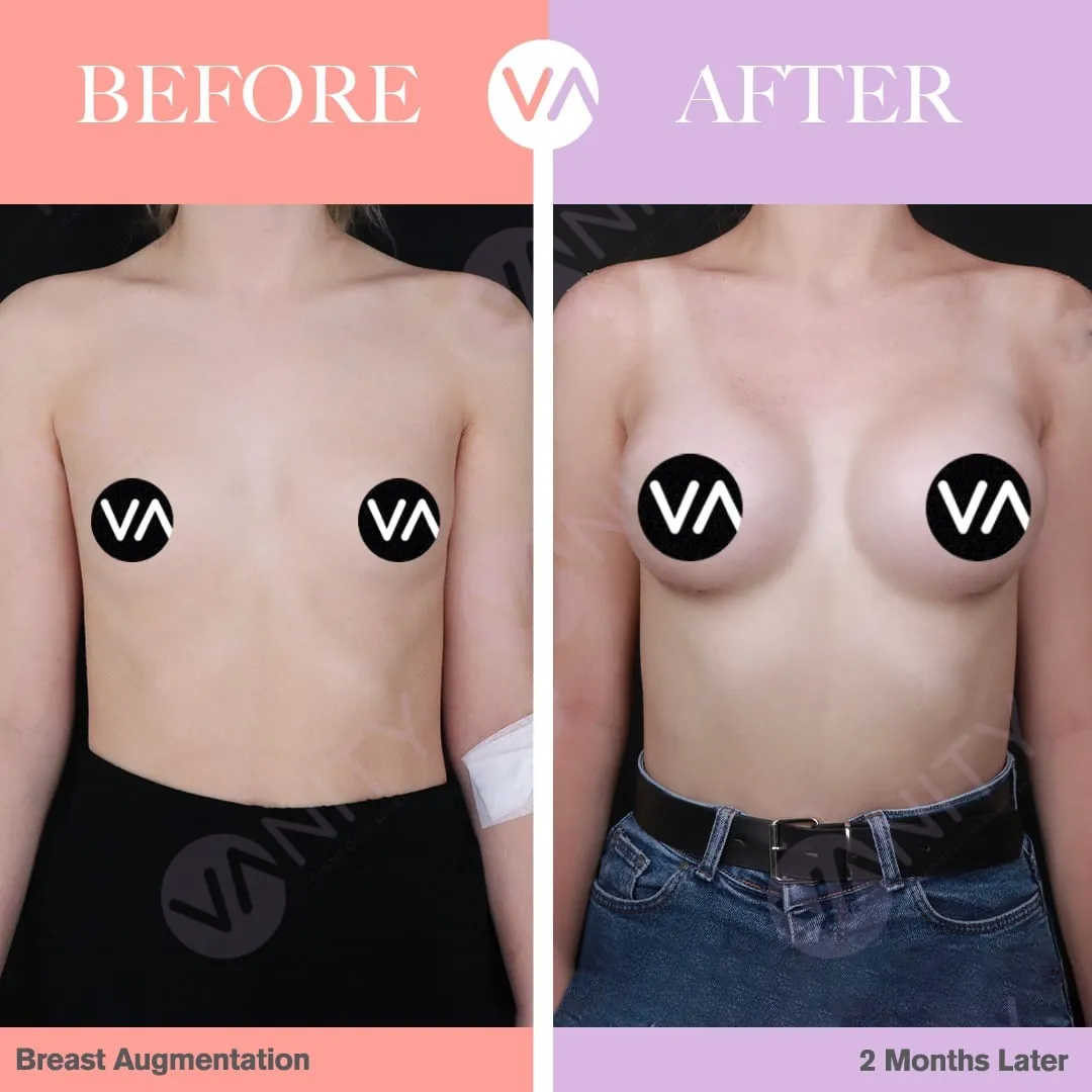 3 Things to Notice in Breast Explant Before and After Photos