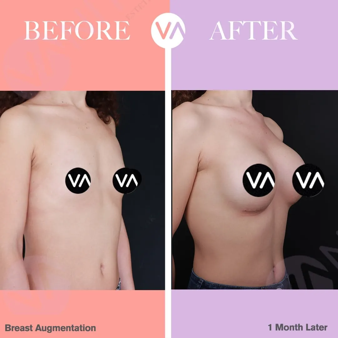 After Breast Augmentation: What Is Normal