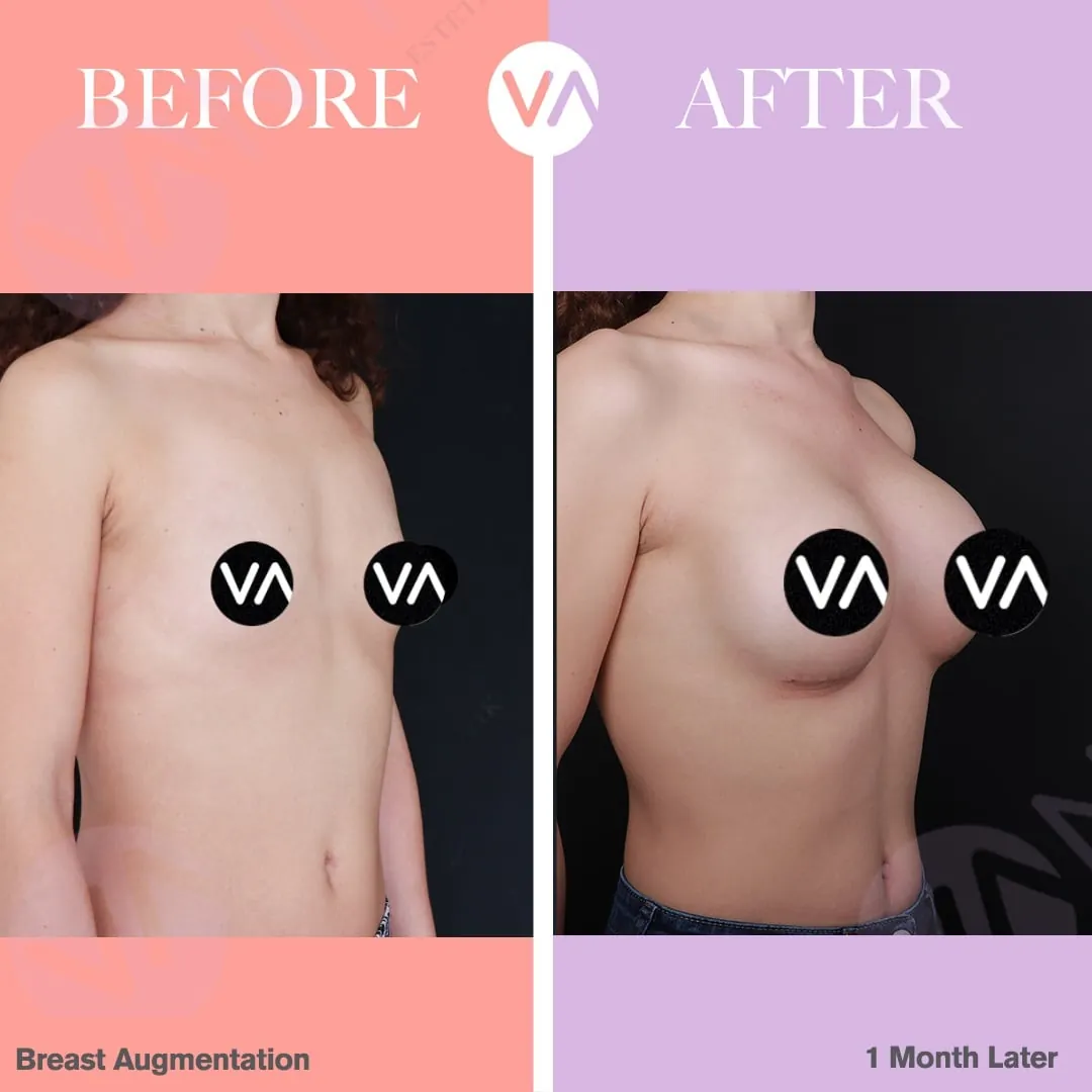 Breast Augmentation Surgery Turkey - Best Clinic and Cost 2024