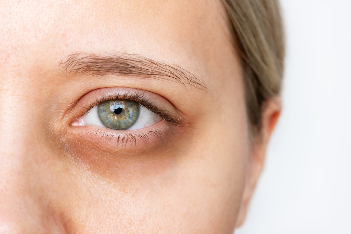 Under Eye Hollows and Dark Circles Treatment | Puffy Eyes NY