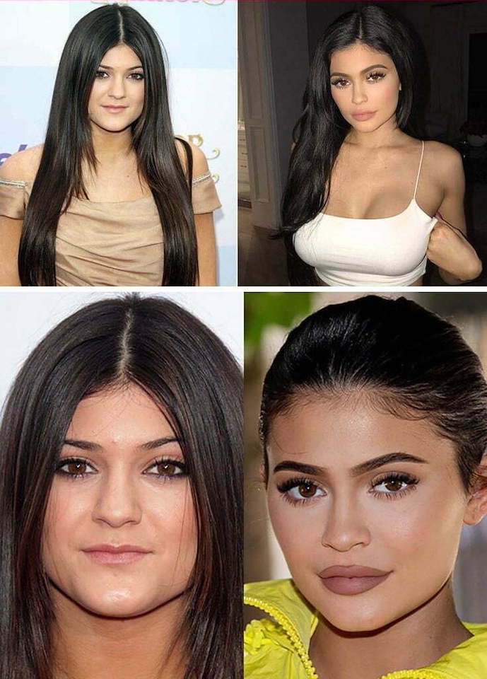 Kylie Jenner Before and After Plastic Surgery Journey