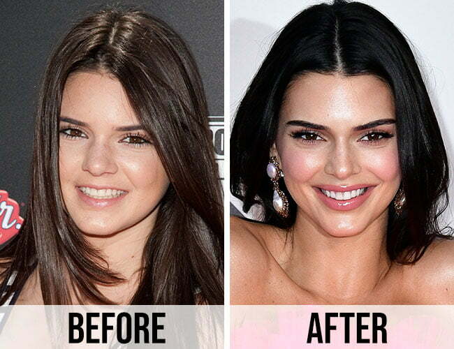 Kendall Jenner Before and After