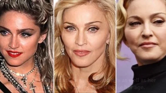 Madonna Before and After Plastic Surgery Journey - Vanity
