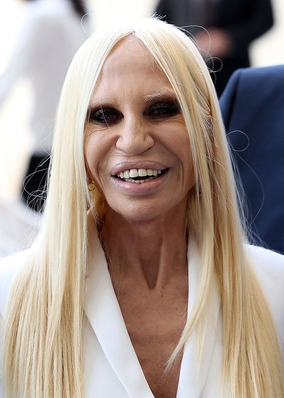 Donatella Versace Before and After Plastic Surgery Vanity