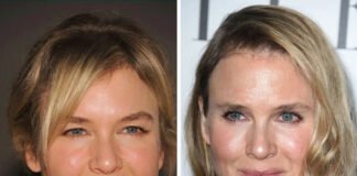 Renée Zellweger Before and After Plastic Surgery